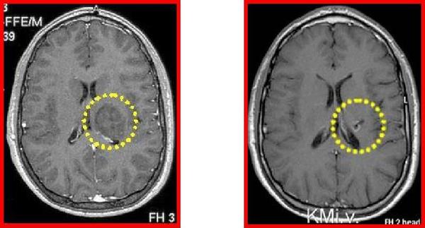 Beispiel eines Behandlungsergebnisses vier Jahre nach Therapie eines Hirntumores mit Seeds: nur noch Nachweis von kleinem Narbengewebe, kein erneutes Tumorwachstum